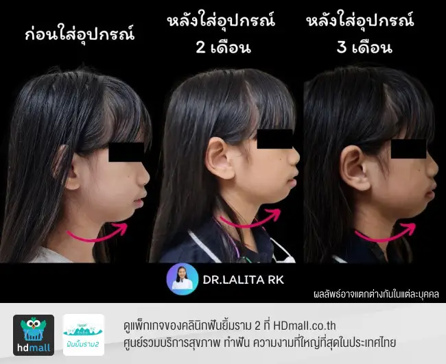 รีวิวใช้อุปกรณ์ช่วยไกด์ขากรรไกรล่าง (Bionator) 3