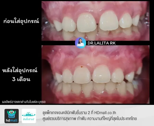 รีวิวใช้อุปกรณ์ช่วยไกด์ขากรรไกรล่าง (Bionator) 4