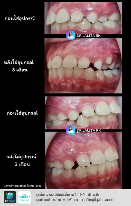รีวิวใช้อุปกรณ์ช่วยไกด์ขากรรไกรล่าง (Bionator) 5