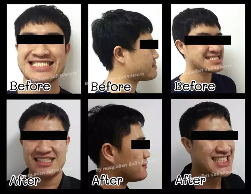 รีวิว จัดฟันร่วมกับผ่าตัดขากรรไกร ที่ คลินิกฟันยิ้ม ราม 2