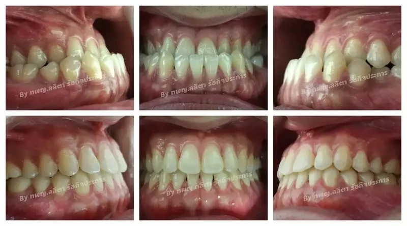 รีวิว จัดฟันร่วมกับผ่าตัดขากรรไกร ที่ คลินิกฟันยิ้ม ราม 2