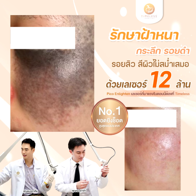 ผลลัพธ์หลังทำ Pico Enlighten ที่ Timeless Laser Clinic รูปที่ 1