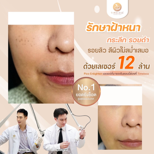ผลลัพธ์หลังทำ Pico Enlighten ที่ Timeless Laser Clinic รูปที่ 2