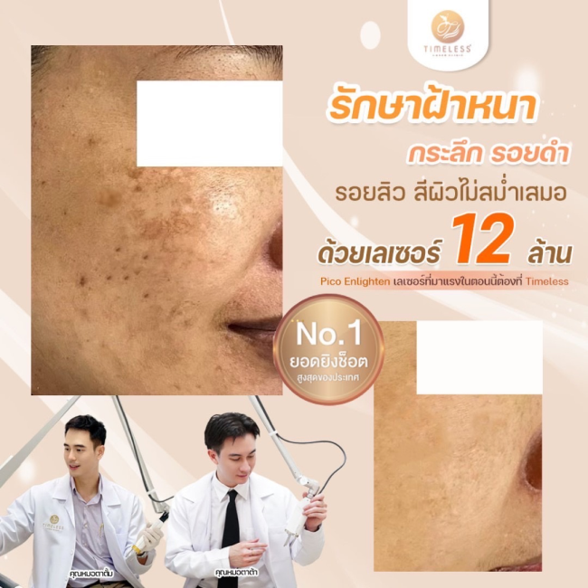 ผลลัพธ์หลังทำ Pico Enlighten ที่ Timeless Laser Clinic รูปที่ 3