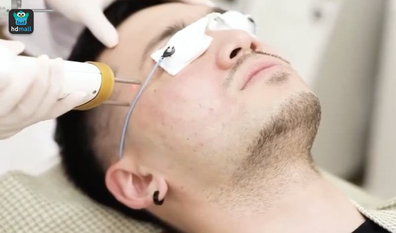 ทำ Pico Laser เจ็บไหม?