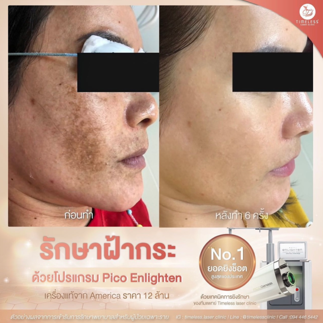 ผลลัพธ์หลังทำ Pico Enlighten ที่ Timeless Laser Clinic รูปที่ 4