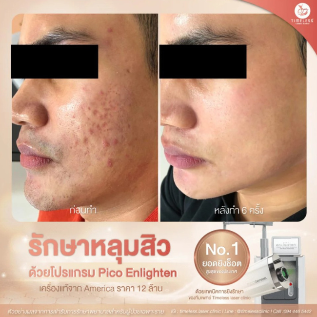 ผลลัพธ์หลังทำ Pico Enlighten ที่ Timeless Laser Clinic รูปที่ 6