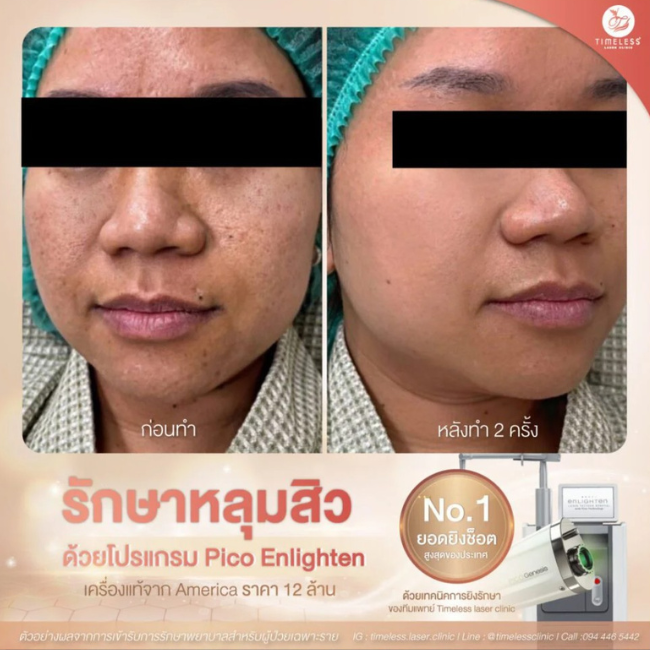 ผลลัพธ์หลังทำ Pico Enlighten ที่ Timeless Laser Clinic รูปที่ 7