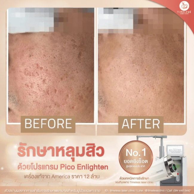 ผลลัพธ์หลังทำ Pico Enlighten ที่ Timeless Laser Clinic รูปที่ 8