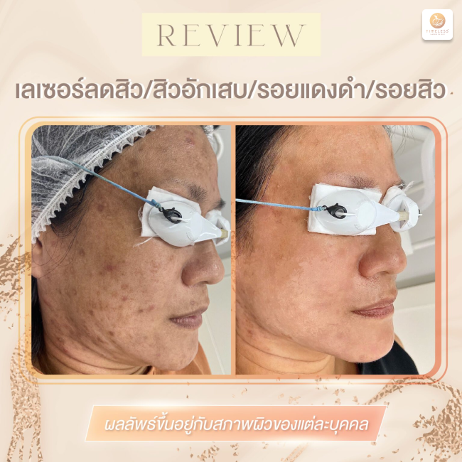 ผลลัพธ์หลังทำ Pico Enlighten ที่ Timeless Laser Clinic รูปที่ 5