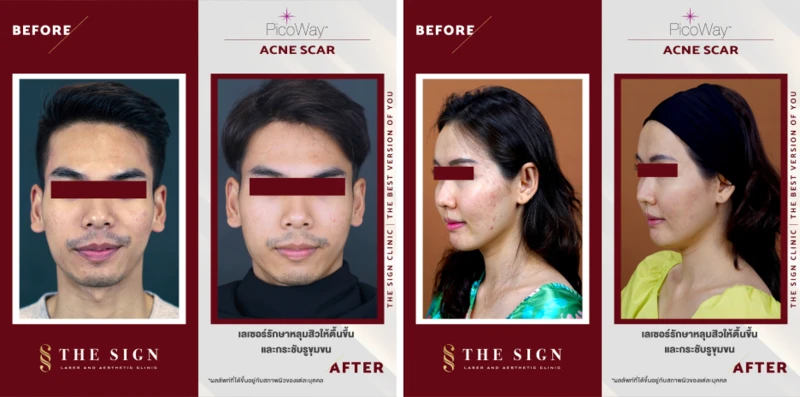 content hdinsight picoway laser for acne scars at the sign clinic3