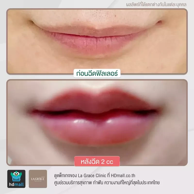 content hdinsight precautions for injecting lip fillers by la grace clinic2