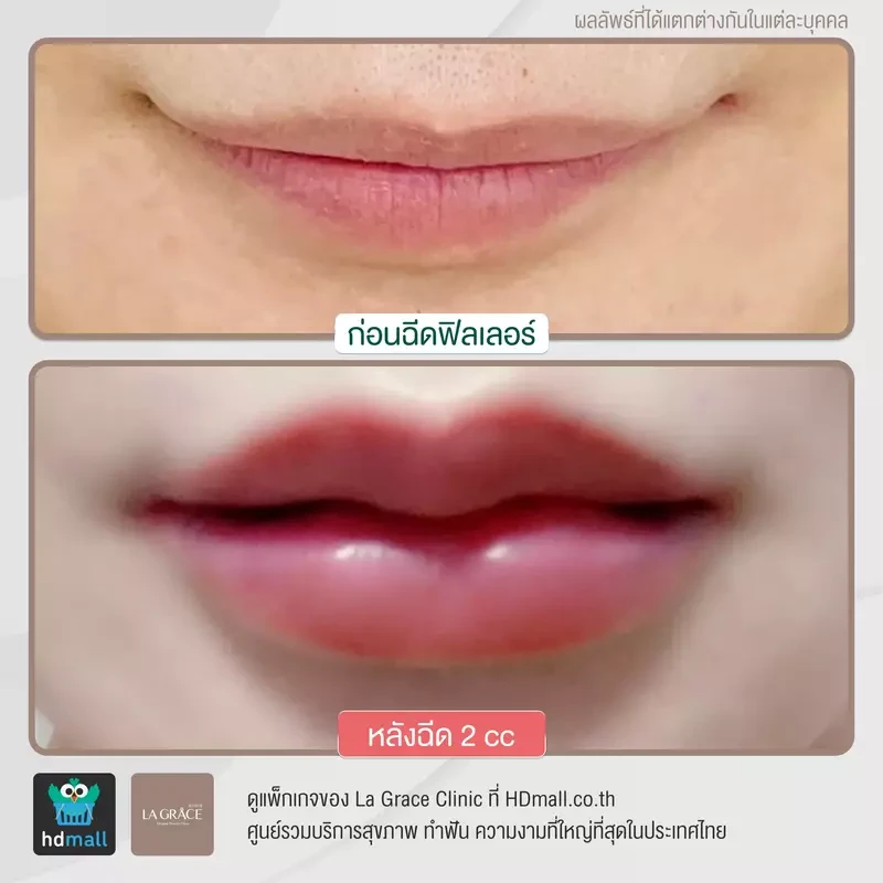 ภาพรีวิวเปรียบเทียบก่อนและหลังฉีดฟิลเลอร์ปาก ที่ La Grace Clinic