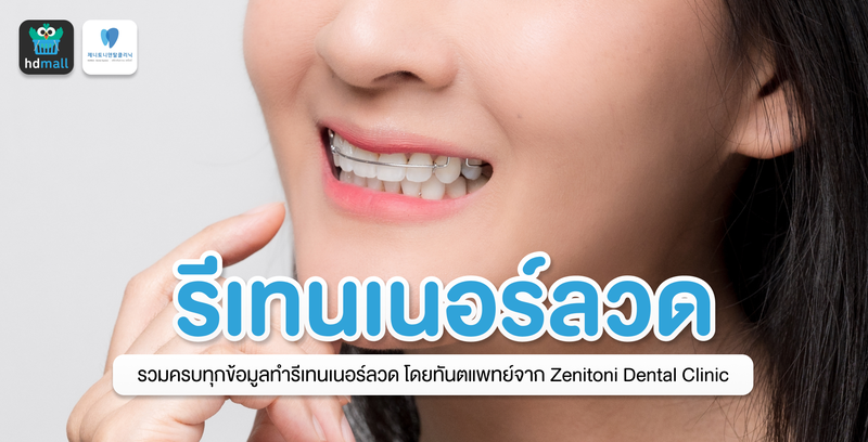 รีเทนเนอร์ลวด แข็งแรง ทนทาน ที่ Zenitoni Dental Clinic
