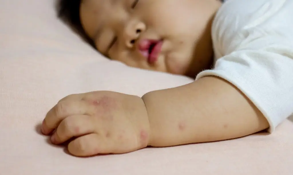 ระวัง! โรคมือ เท้า ปาก สายพันธุ์ EV71 อาจทำลูกป่วยหนักถึงขั้นเสียชีวิต