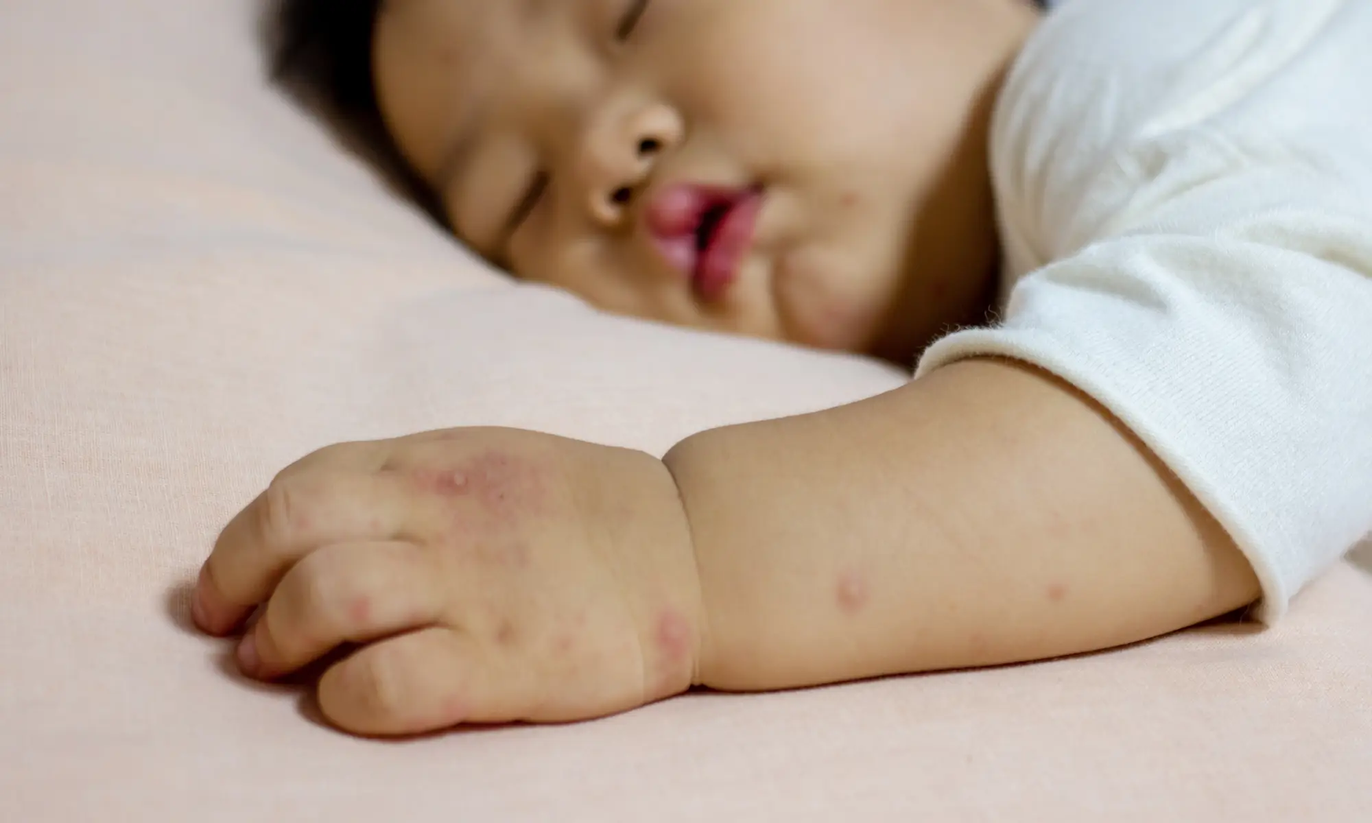 hand foot mouth ev 71 disease definition