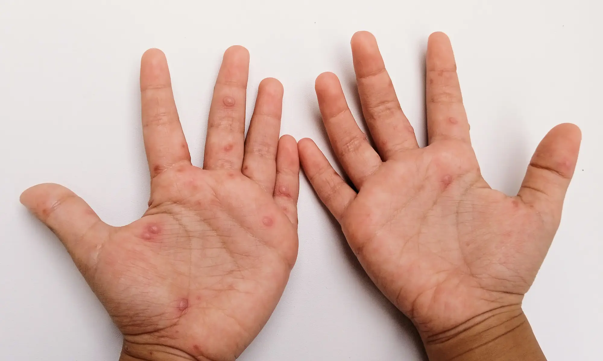 hand foot mouth in children disease definition