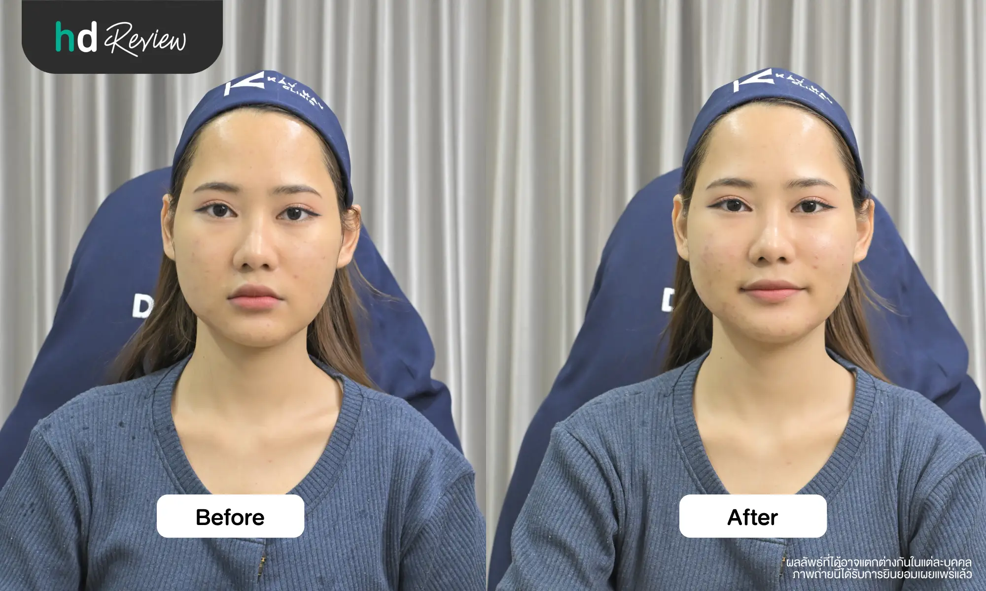 ผลลัพธ์หลังทำโปรแกรม Biostimulator