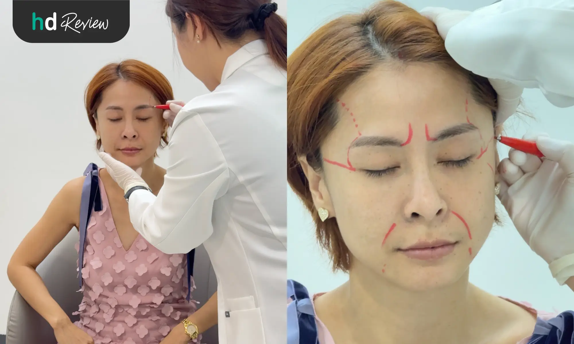 ขั้นตอนปรึกษาคุณหมอพร้อมกับวาดมาร์กจุดว่าจะผ่าตัดดึงหน้าตรงไหนบ้าง