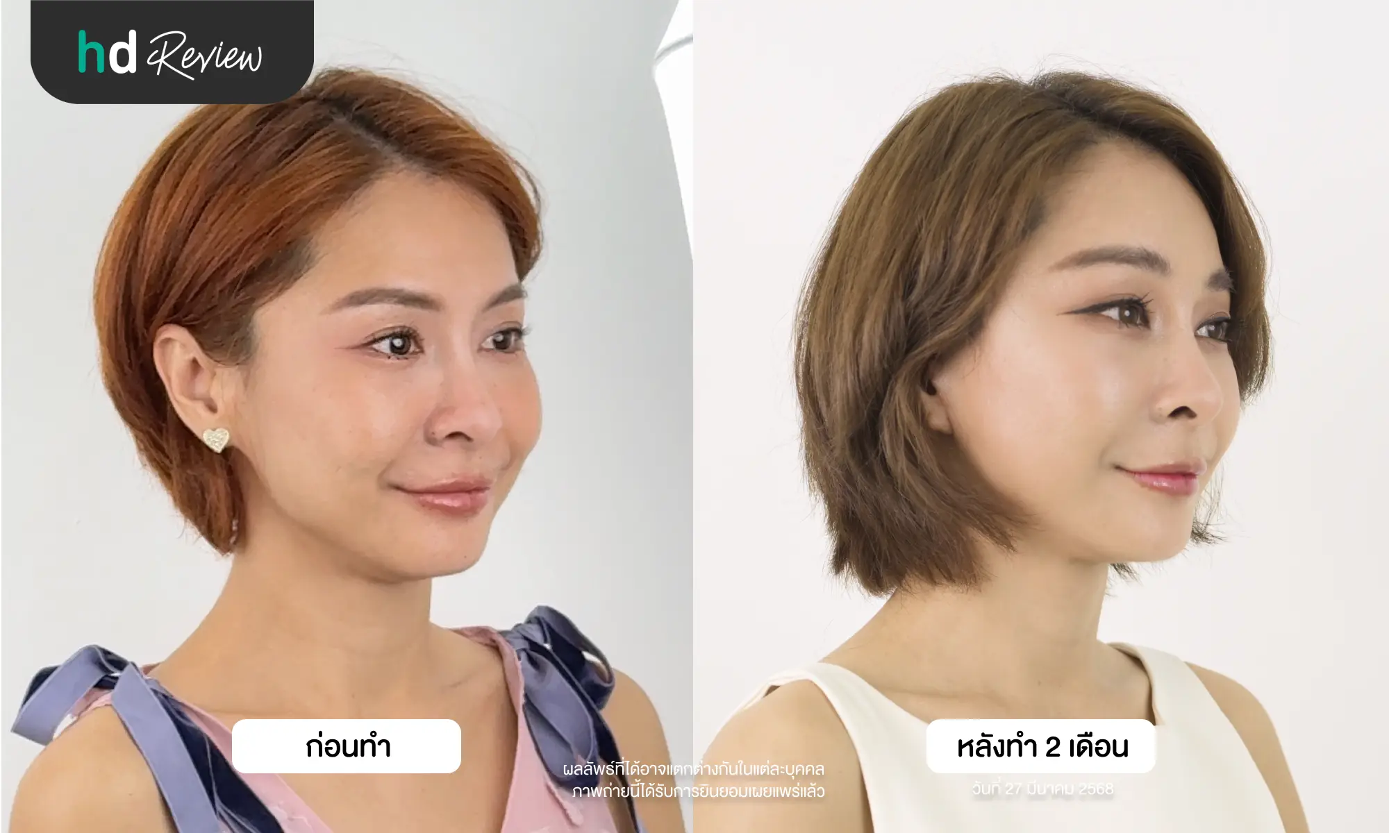 ผลลัพธ์หลังผ่าตัดดึงหน้าและส่องกล้องยกคิ้ว 