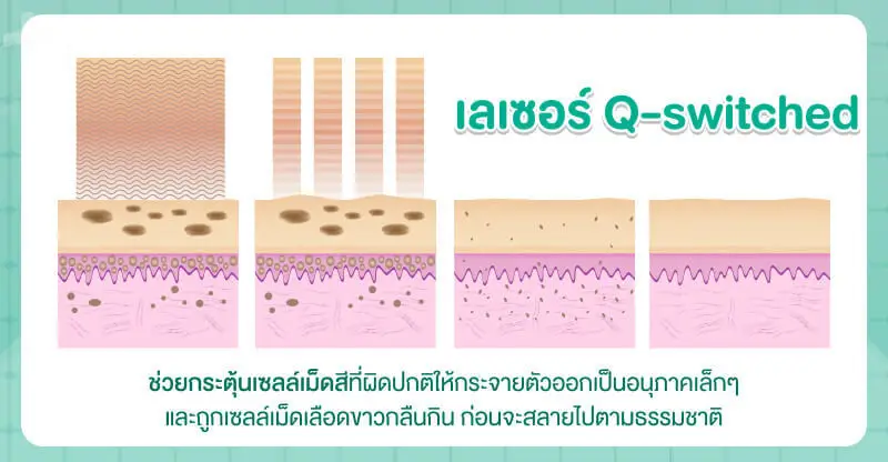 เลเซอร์กระด้วย Q-switched
