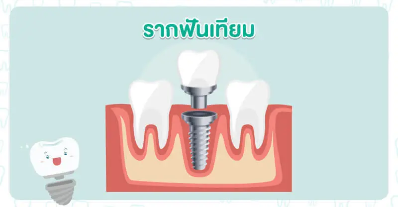 ภาพรากฟันเทียม