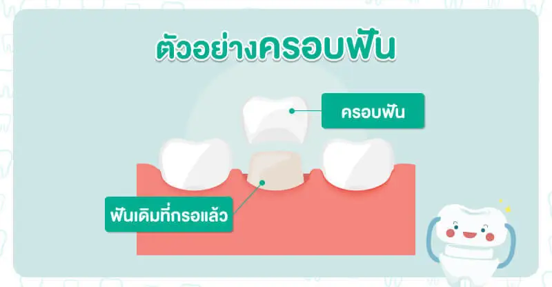 ส่วนประกอบของครอบฟัน