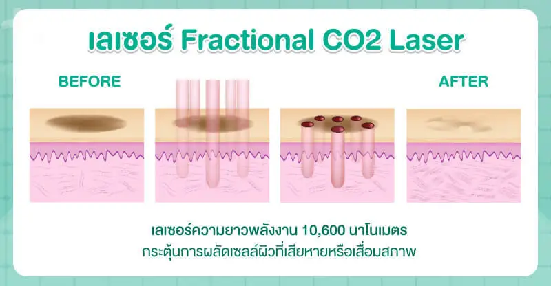 เลเซอร์กระด้วย Fractional CO2 Laser