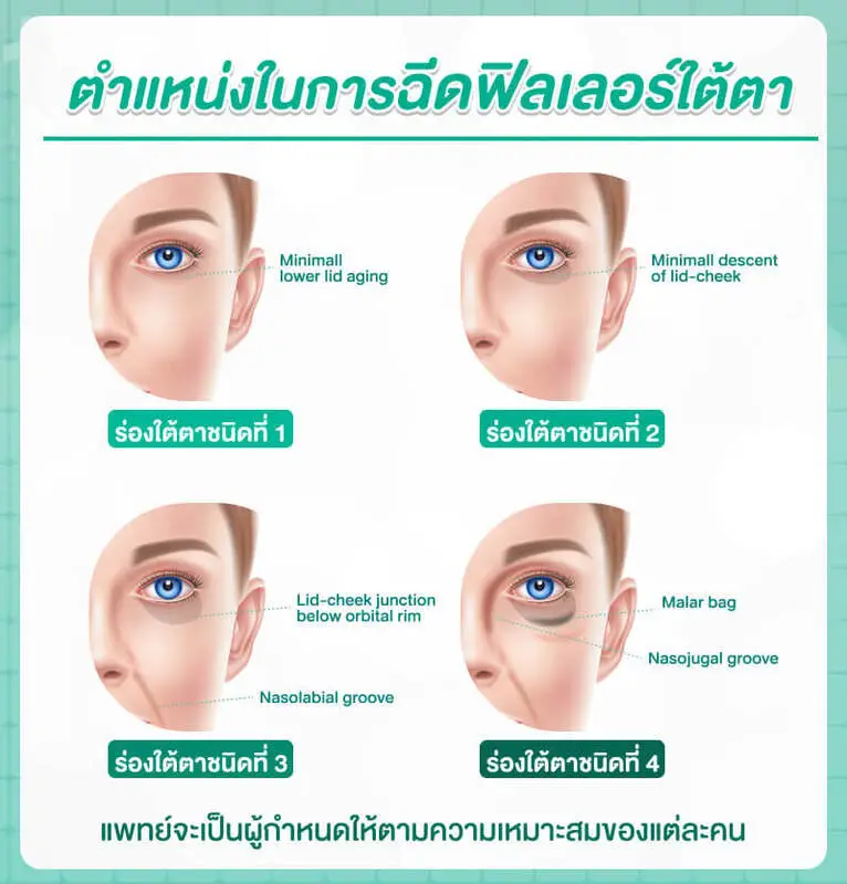 ตำแหน่งในการฉีดฟิลเลอร์ใต้ตา