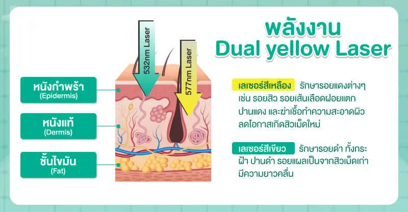 เลเซอร์กระด้วย Dual yellow Laser