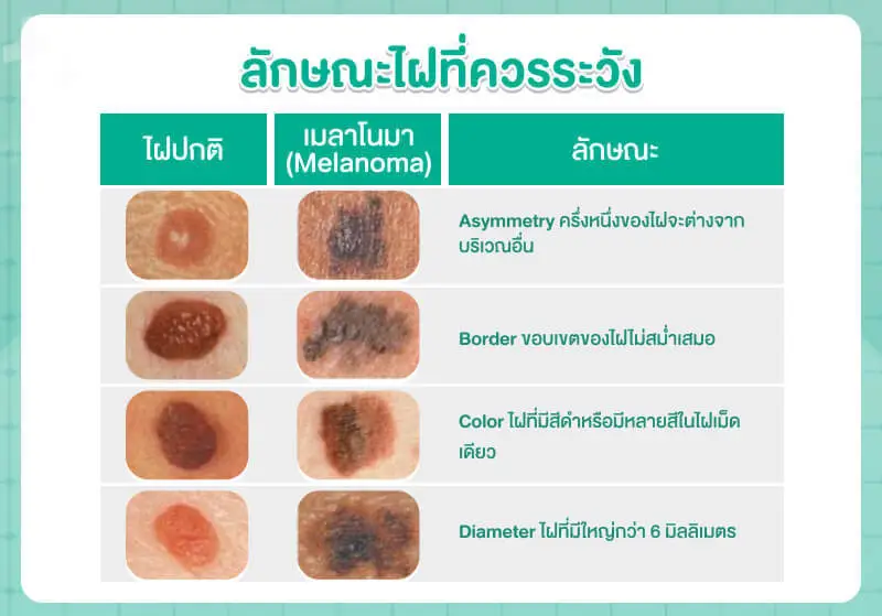 ลักษณะไฝที่ควรระวัง มะเร็ง