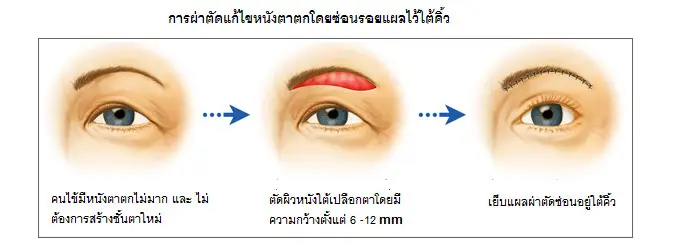 สาเหตุที่ทำให้เปลือกตาตกและหย่อน