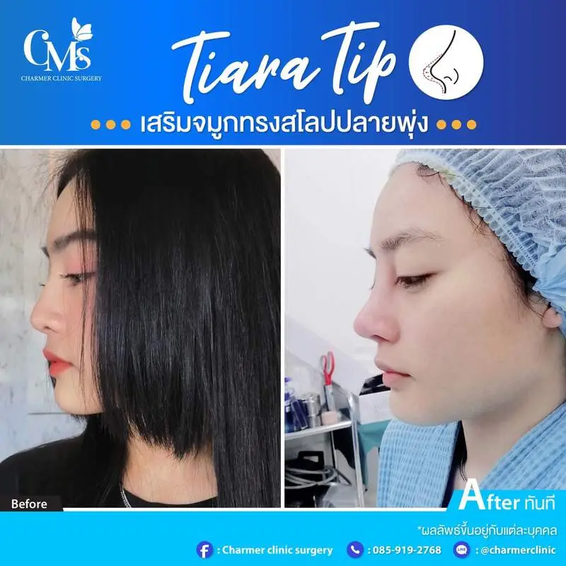 รีวิวเสริมจมูกจากคลินิก