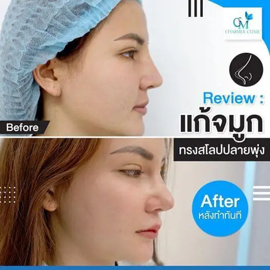 รีวิวเสริมจมูกจากคลินิก