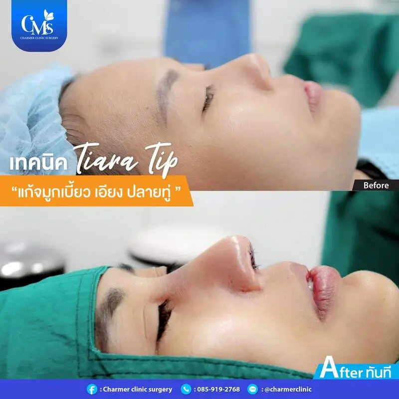 รีวิวเสริมจมูกจากคลินิก