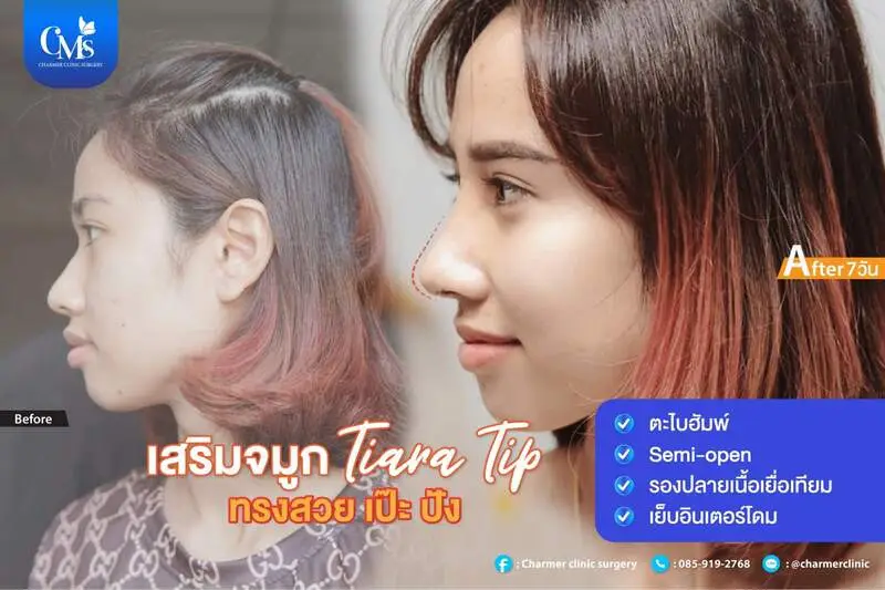 รีวิวเสริมจมูกจากคลินิก