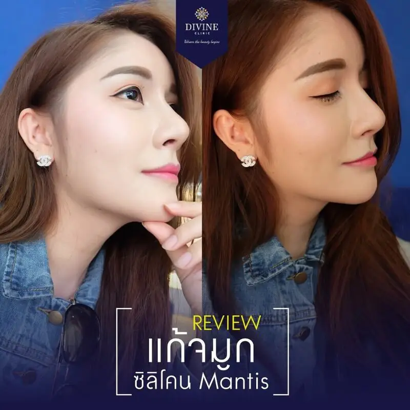 รีวิวเสริมจมูกจากคลินิก