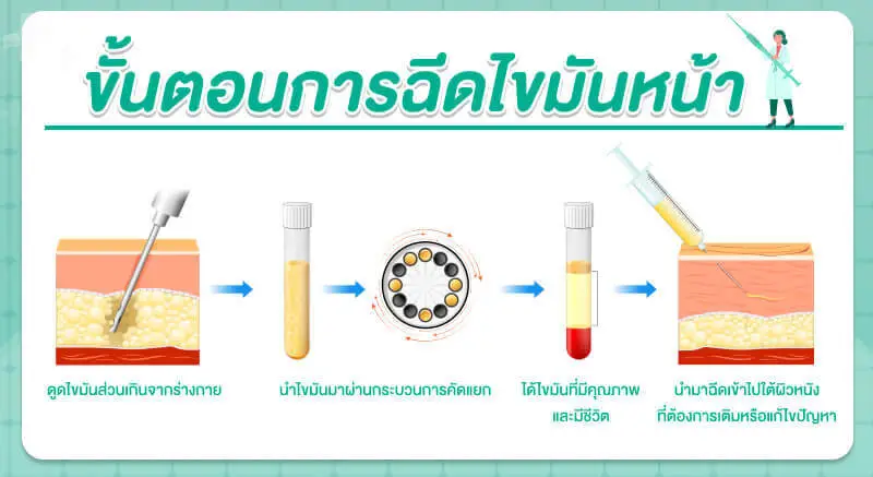 ขั้นตอนการฉีดไขมันหน้า