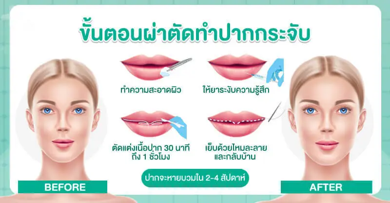 ขั้นตอนการทำปากกระจับ