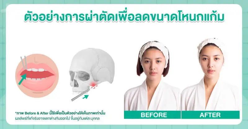 ตัวอย่างการผ่าตัดเพื่อลดขนาดโหนกแก้ม