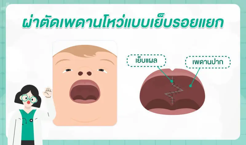 ตำแหน่งในการผ่าตัดปากแหว่งเพดานโหว่