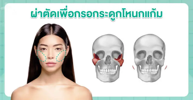 การผ่าตัดเพื่อกรอกระดูกโหนกแก้ม