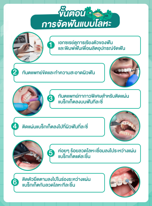 ขั้นตอนการจัดฟันแบบโลหะ