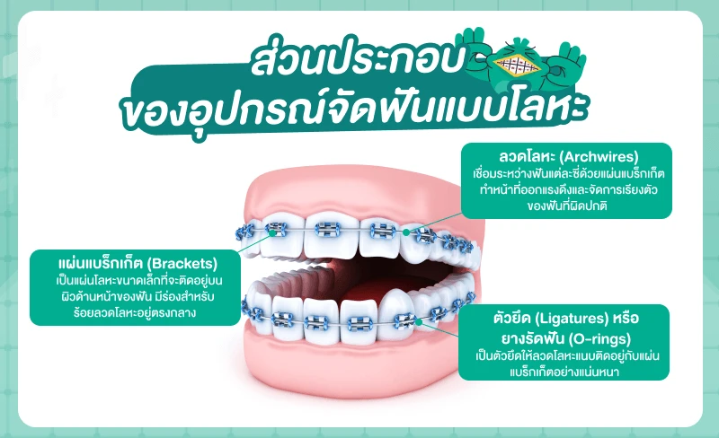 ส่วนประกอบของอุปกรณ์จัดฟันแบบโลหะ