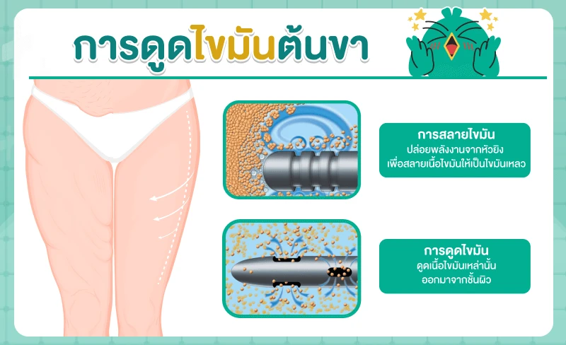 ขั้นตอนการดูดไขมันต้นขา