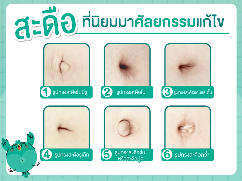 สะดือที่คนมักมาทำศัลยกรรมแก้ไข
