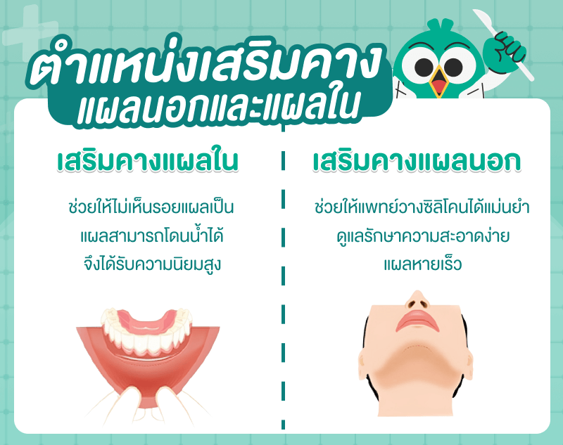 ความแตกต่างระหว่างเสริมคางแผลนอกกับแผลใน