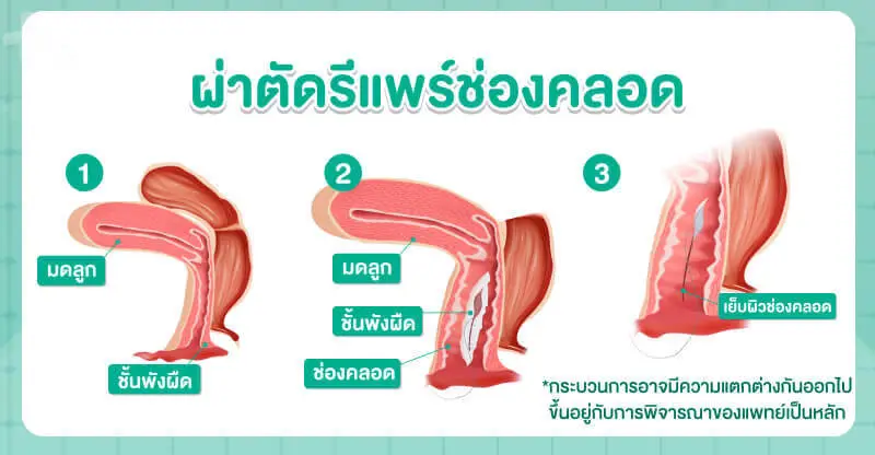 การผ่าตัดรีแพร์ช่องคลอด