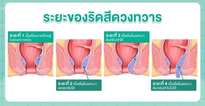 ริดสีดวงทวารมี 4 ระยะ