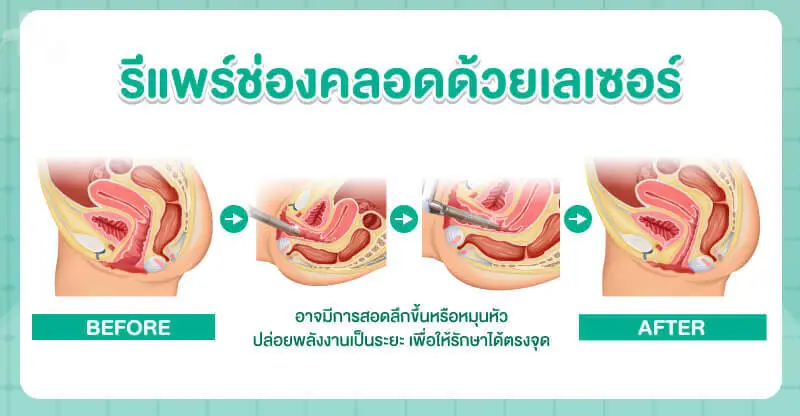 รีแพร์กระชับช่องคลอดด้วยการผ่าตัด